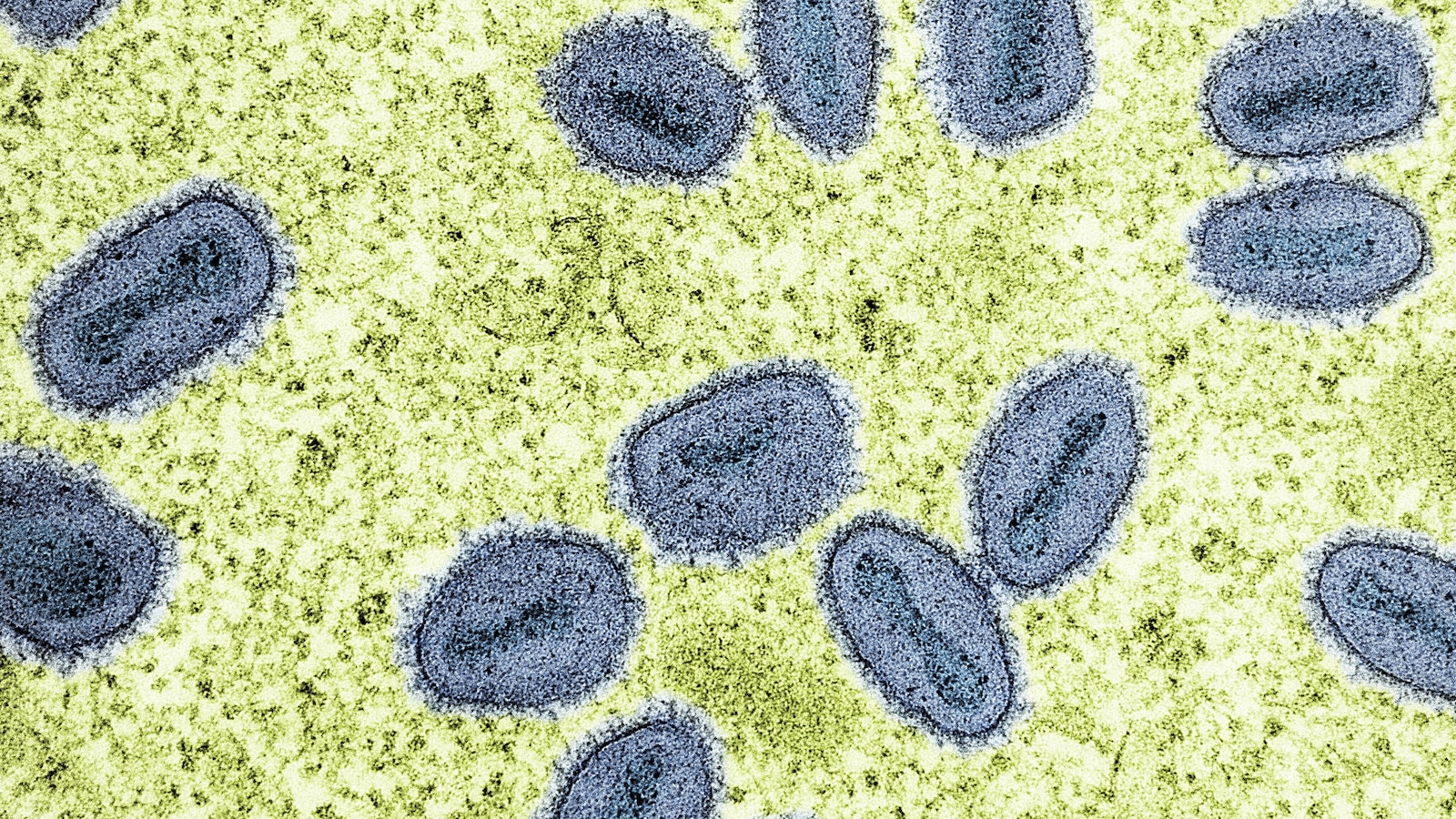 California officials confirm 1st US case of severe mpox strain with no travel history