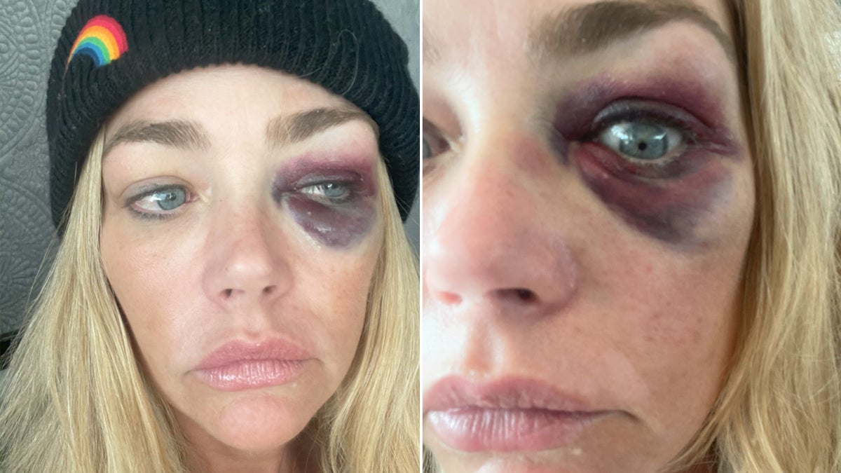 Denise Richards with a black eye.