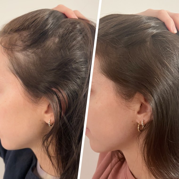 Commerce editor and producer Julie Ricevuto before and after using the SickScience Scalp Serum, Nioxin Hair Fall Defense Shampoo and HigherDose Red Light Hat.