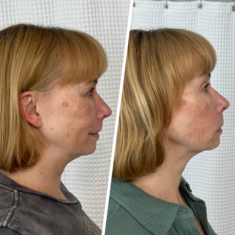 Freelance writer Tanya Edwards before and after using the SickScience Jawline Serum 
